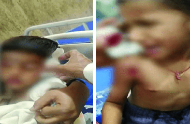 ಹುಚ್ಚುನಾಯಿ ಅಟ್ಟಹಾಸ ಐವರು ಮಕ್ಕಳಿಗೆ ಗಂಭೀರ ಗಾಯ